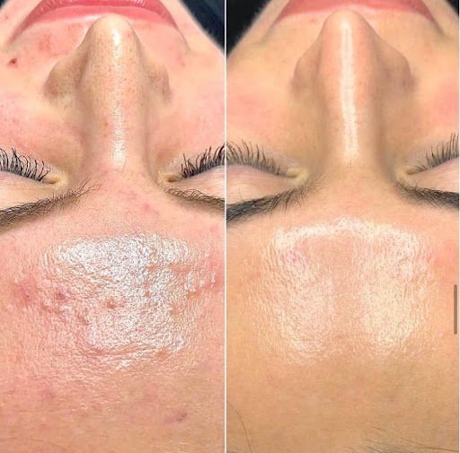 Bio repeel ( chemical peel)