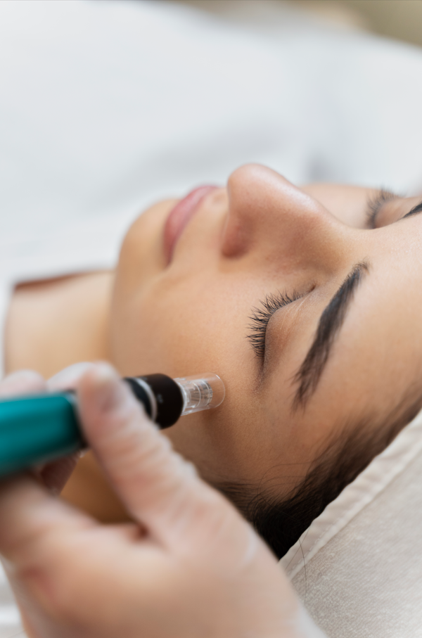 Microneedling