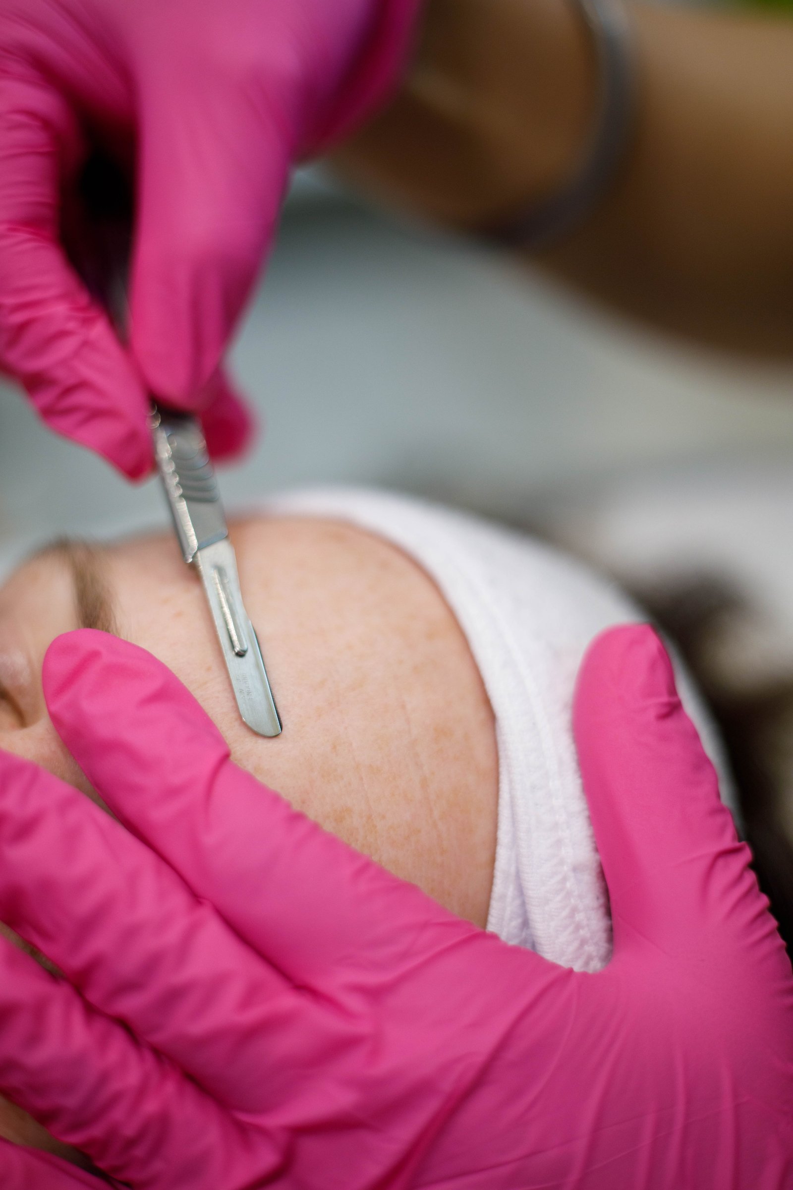 Dermaplaning